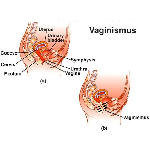 Hypoactive Sexual Desire Disorder information